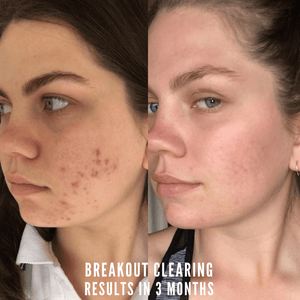 Tribe Skincare Clearing Anti-Breakout Serum reviews